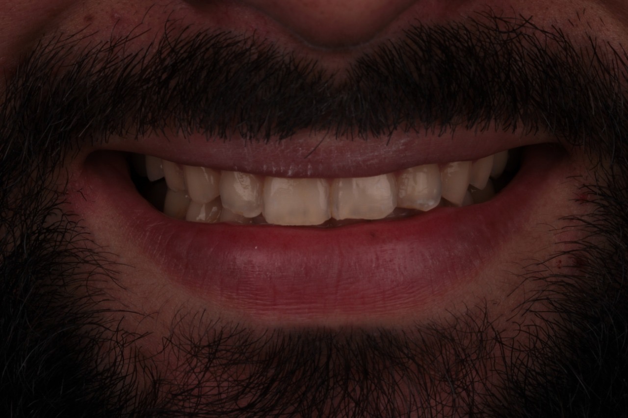 Antes implante dentário