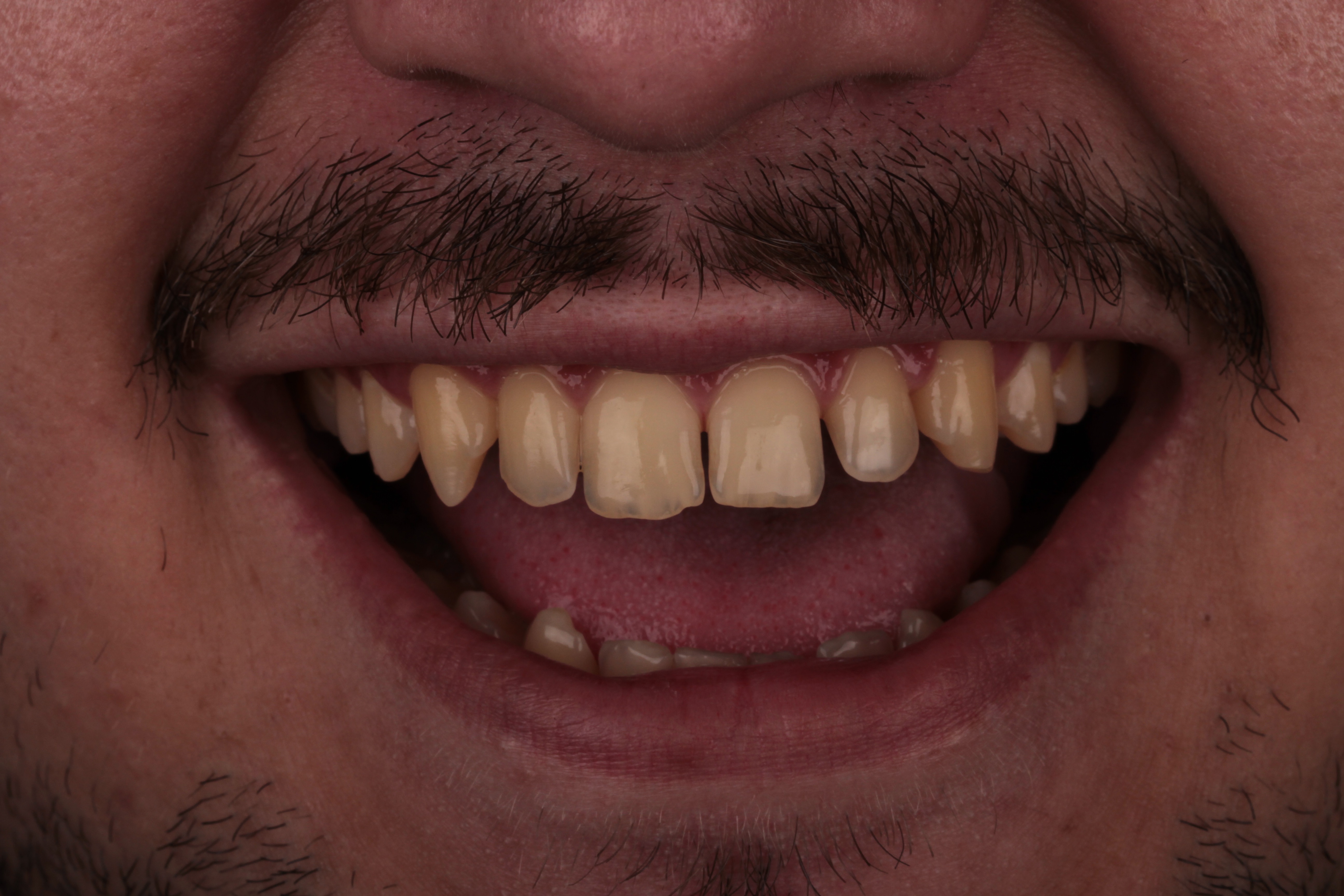 Antes implante dentário