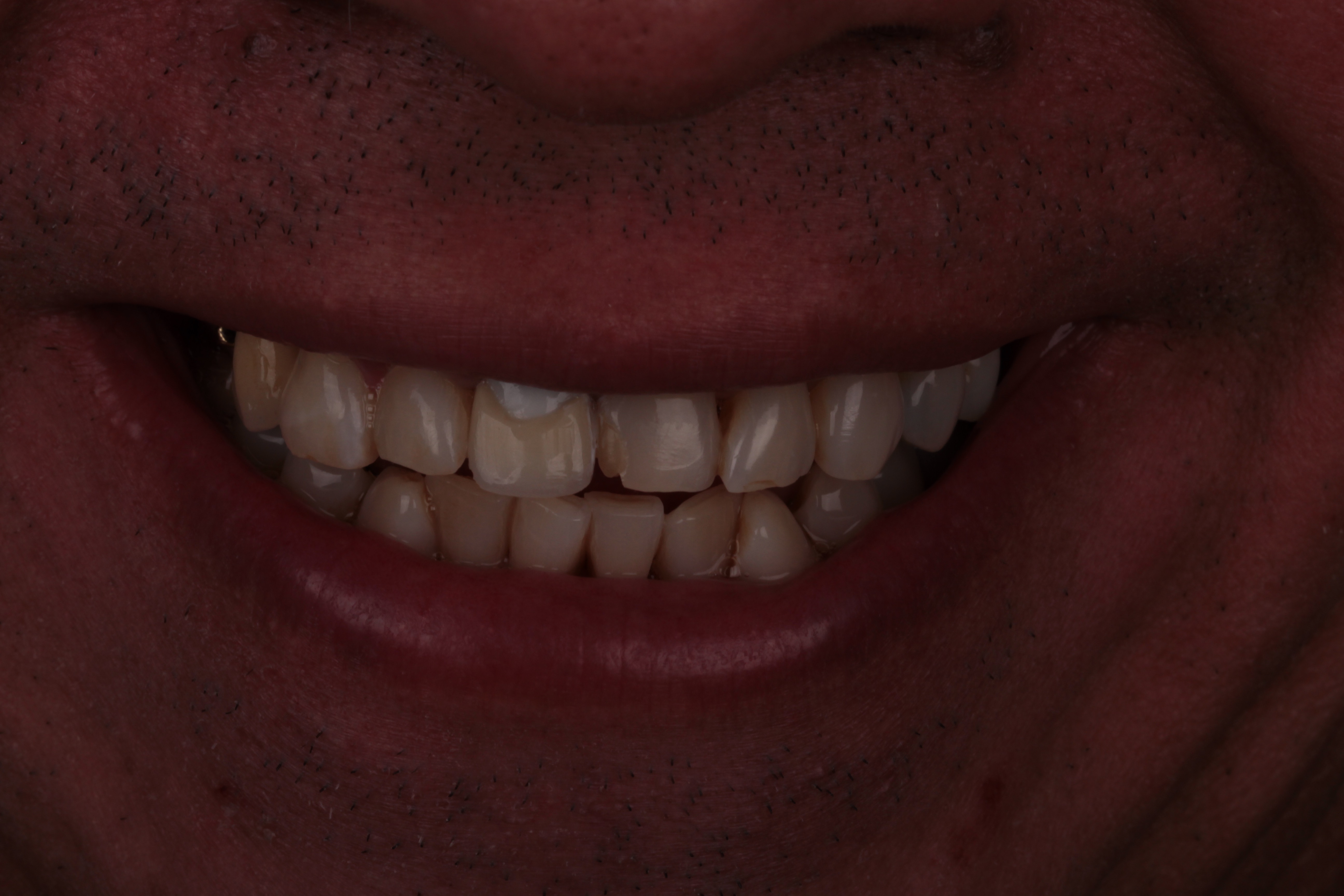 Antes implante dentário