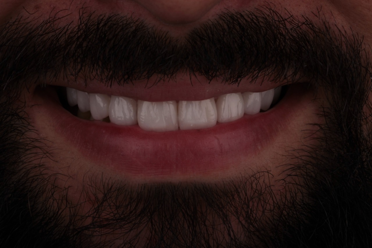 Depois implante dentário