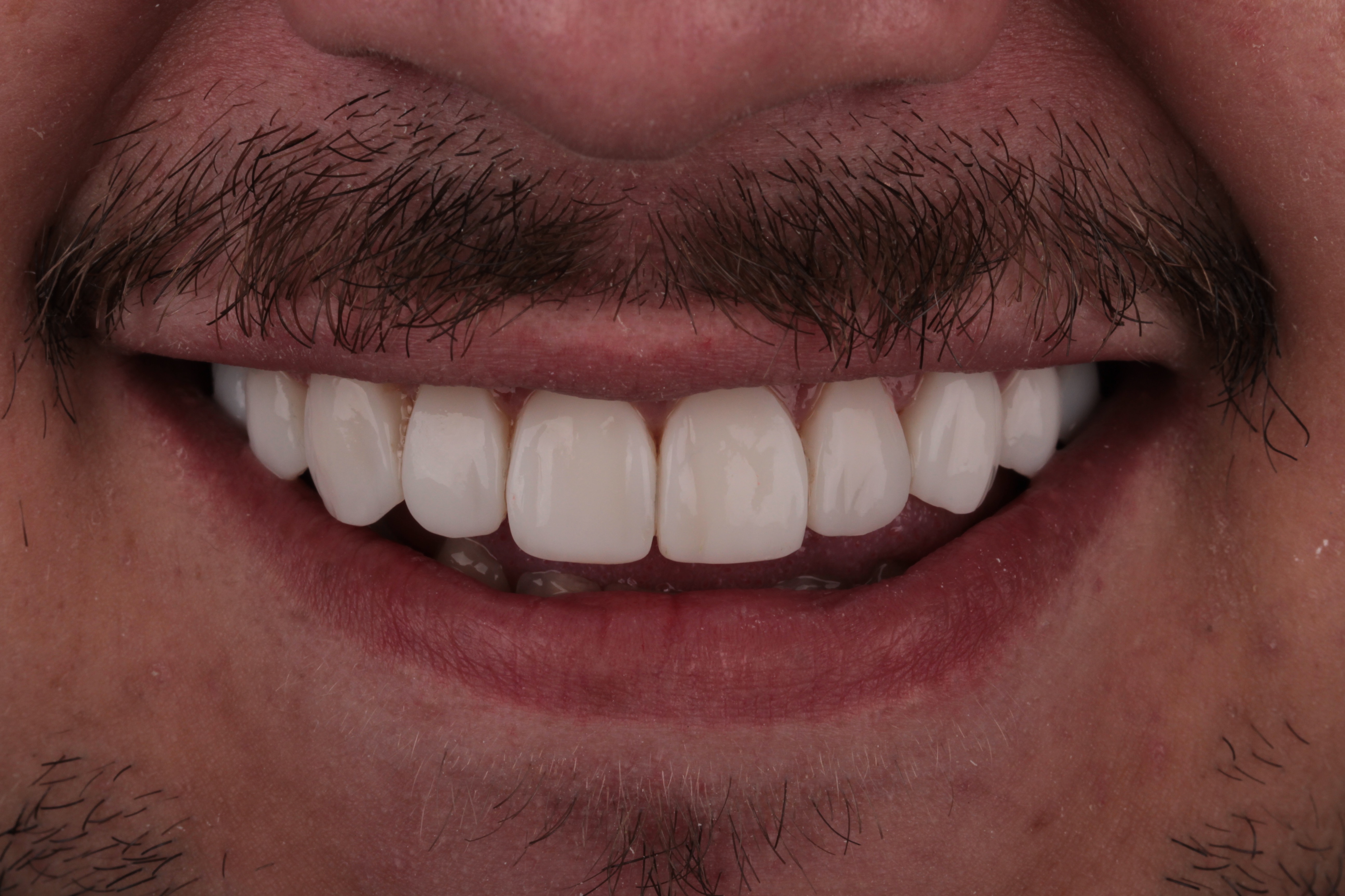 Depois implante dentário