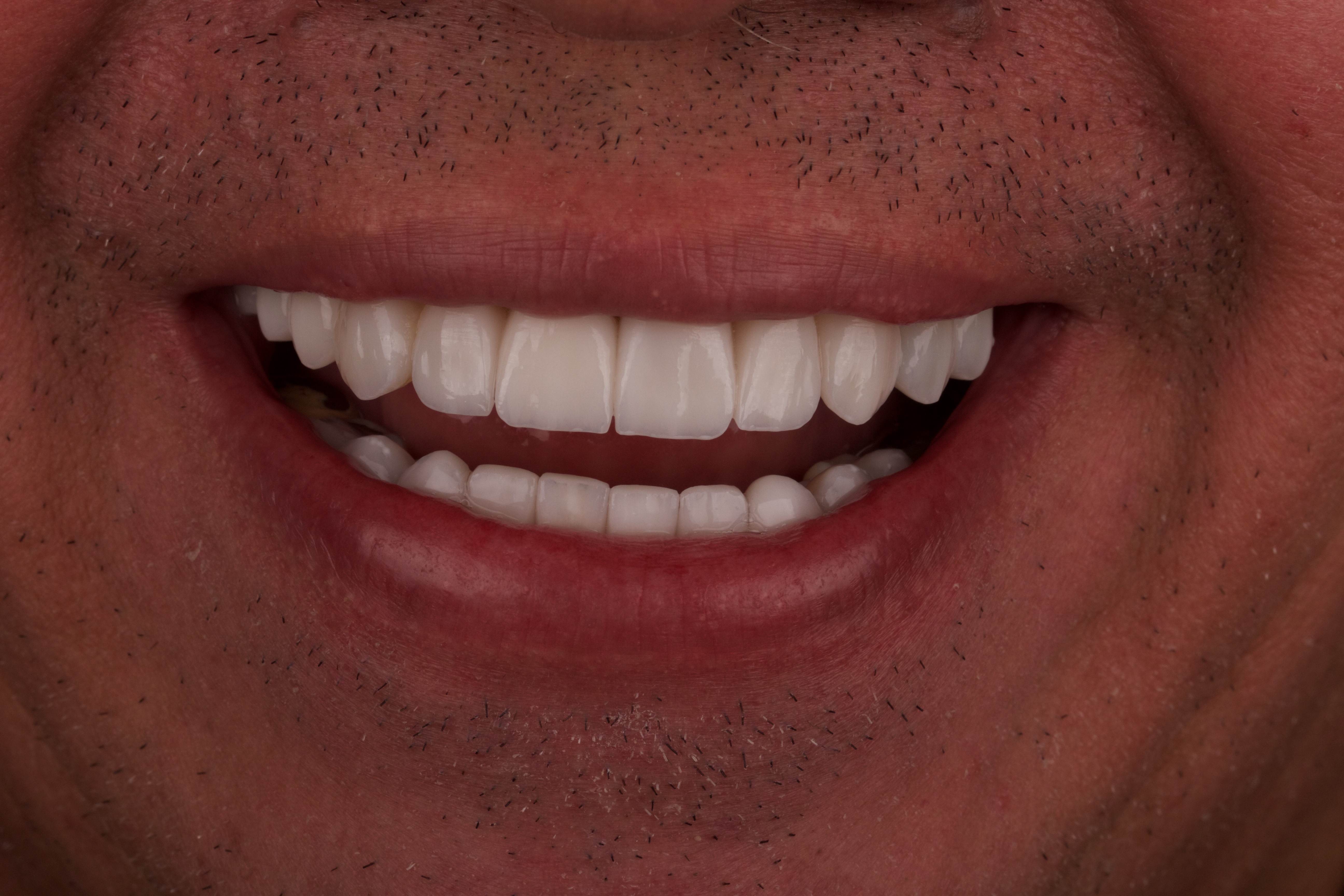 Depois implante dentário